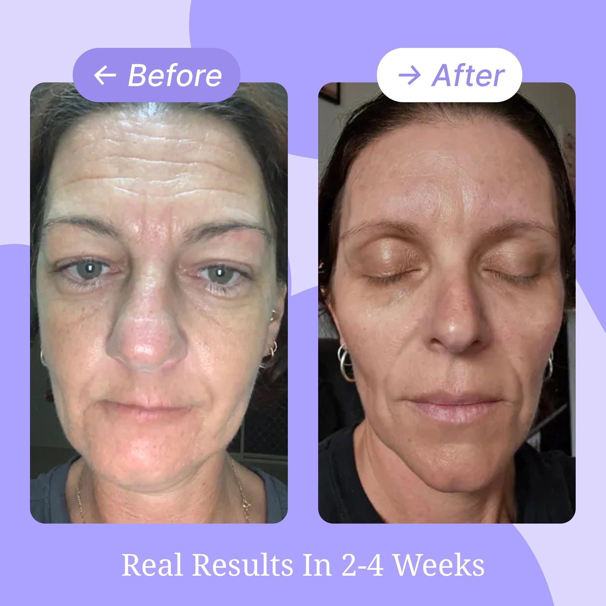 Mouth & Lip Wrinkle Patches